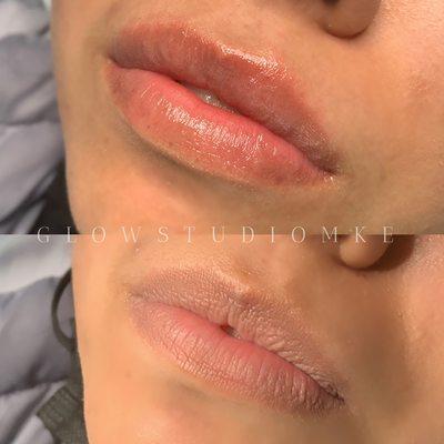 Needle-less lip filler