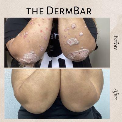 Psoriasis