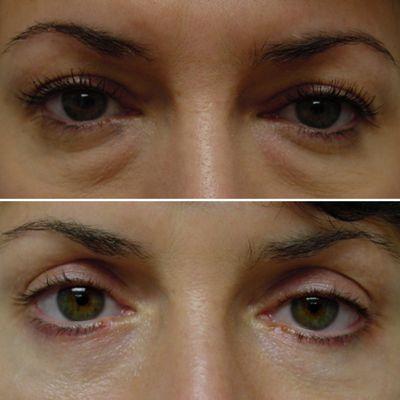 Lower Eyelid Rejuvenation with Blepharoplasty, performed under local anesthesia. Patients can walk out of the office the same day.