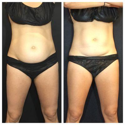 Treat unwanted belly fat with CoolSculpting at Metro Laser!