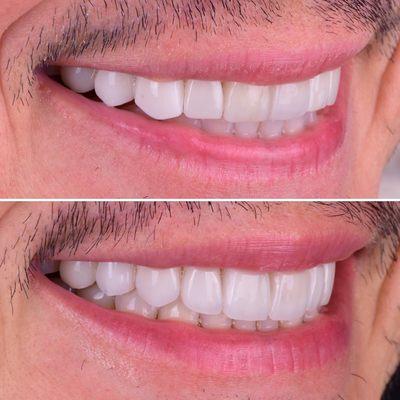 Porcelain veneers revision