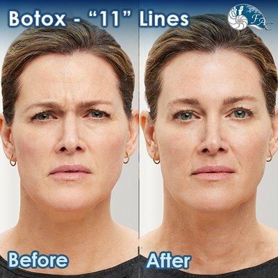 Botox: "11" Lines - Before & After Results Please Call (949) 313-2600