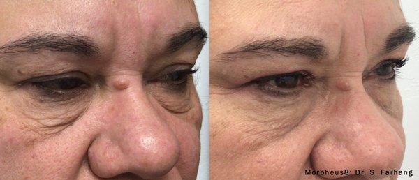 Under eye and wrinkle treatment with Morpheus8 / Morpheus RF Microneedling.  The most popular collagen promoting skin remodeling treatment.