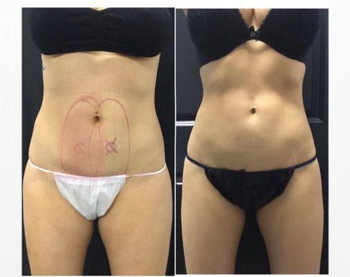 Coolsculpting post 1 treatment