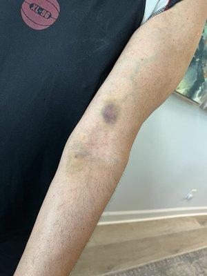 Bruise after service was performed.