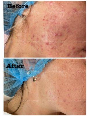 Plasma with Acne Ampoule is non-invasive, only takes 25 minutes, and has zero recovery time.