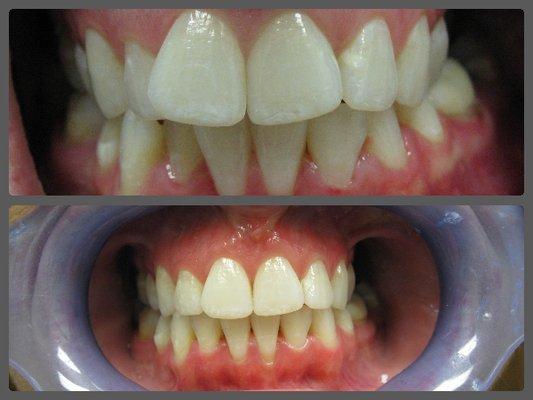 invisalign before/after