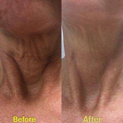 Ultherapy of my neck and it will continue to improve over the next 3-6 months