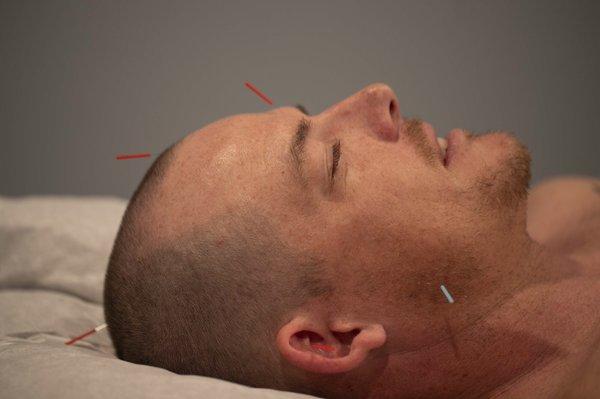 Acupuncture