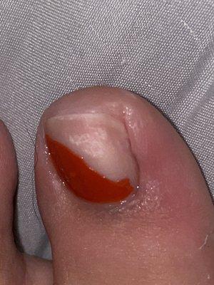 My infected toe. And I had to take the nail polish off.   Literally never had this happen in my life