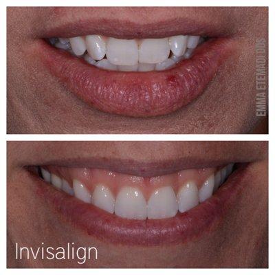 Straighten teeth with clear aligners!