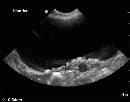 bladder stones may cause blood in urine.