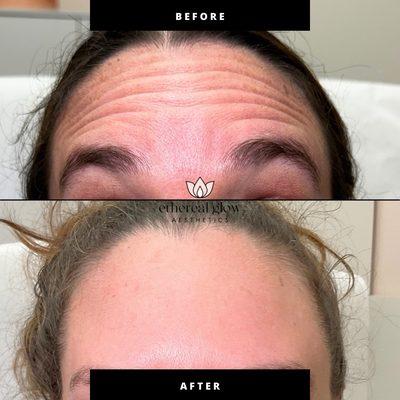 Smooth forehead results and no wrinkles after tox treatment!