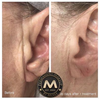 Plasma Pen Fibroblast Skin tightening -Plasma Pen will lift and remove deep wrinkles in one session- no surgery