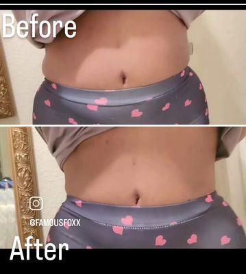 Laser Lipo Before and After