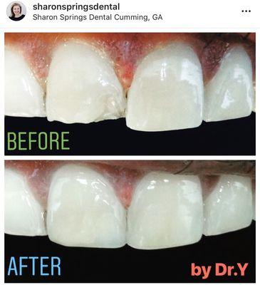 Cosmetic teeth bondings. Tooth chip repair.