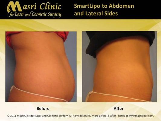 After SmartLipo, the non-surgical alternative to liposuction, her abdomen is leaner & post-pregnancy sagging skin has tightened.