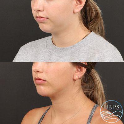 Submental Liposuction and Chin Augmentation