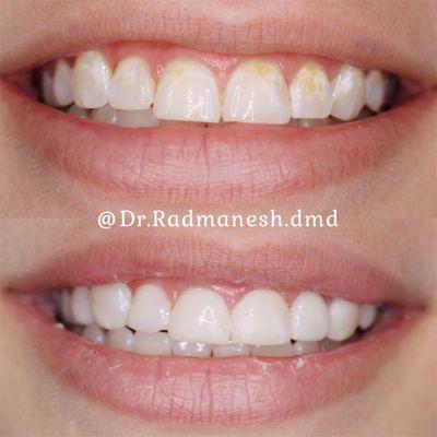 Composite Veneer Transformation