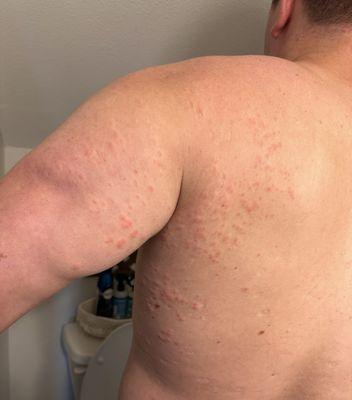 BEDBUG BITES!!!