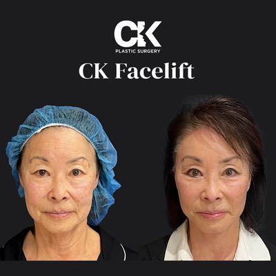 CK Plastic Surgery Facelift