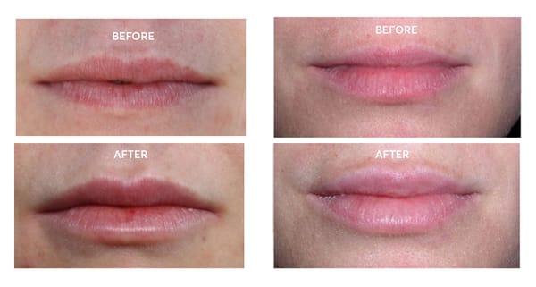 @Alchemy we specialize in the "moisturized look" for lips; over time our lips lose volume, let us help plump your pout back to what it was!