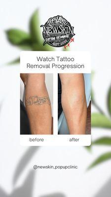 New Skin Tattoo Removal Pop-Up Clinic