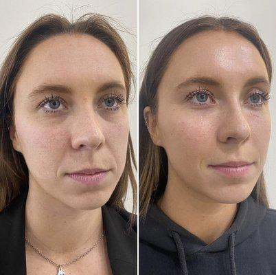 Before & After Filler