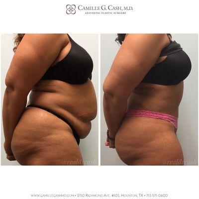 Tummy Tuck with Liposuction and Hernia Repair