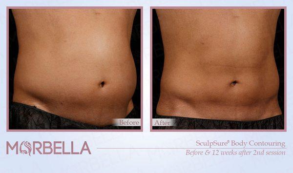 Marbella MedSpa-Sculpsure Body Contouring Before & After