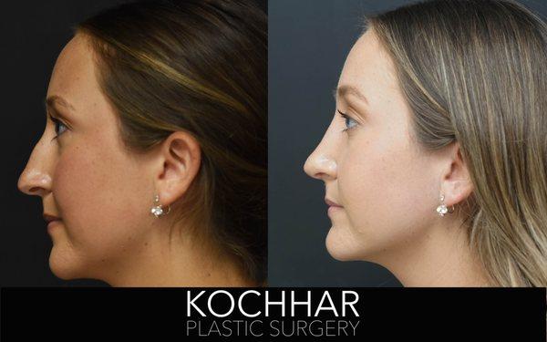 Before and After Rhinoplasty