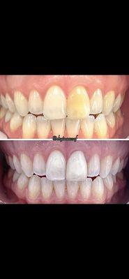 Veneers and Teeth whitening