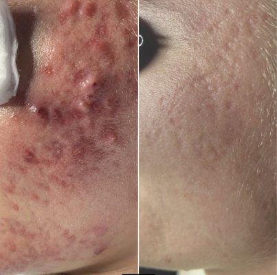 Acne & Scar Revision Treatments