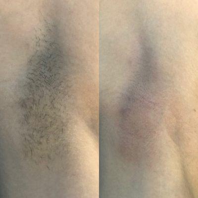 Before and after of waxed underarms.