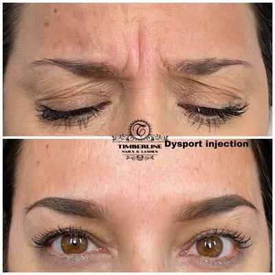 Dysport Injections