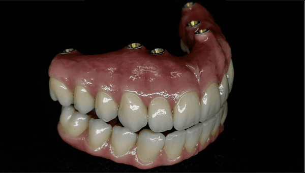 Upper and lower full mouth reconstruction