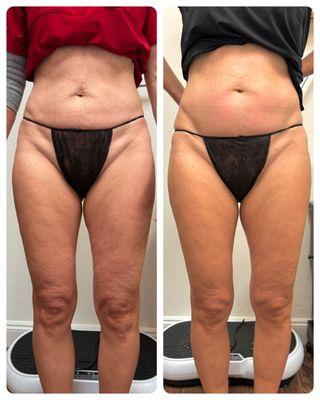 Endospheres Cellulite Treatment