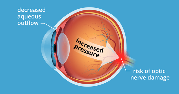 OCULAR HYPERTENSION (OHTN)  is when the pressure inside the eye (intraocular pressure or IOP) is higher than normal. Get regular eye exams!