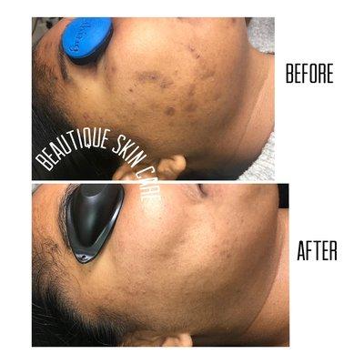 Hyperpigmentation treatment