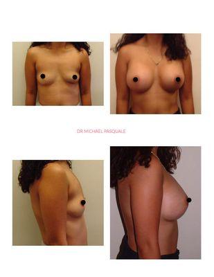 Breast Augmentation Hawaii