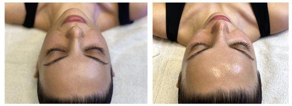 Hydrafacial with Dermaplaning before and after.