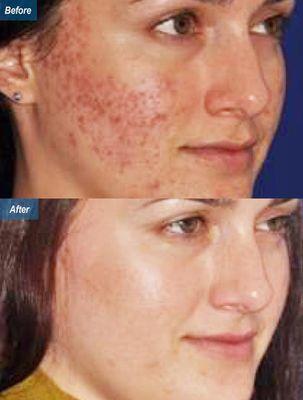 [Micro-Needling] - Before & After Micro-Needling treatment to treat acne. DermLA.com