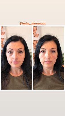 Before and after facial rejuvenation using Restylane.