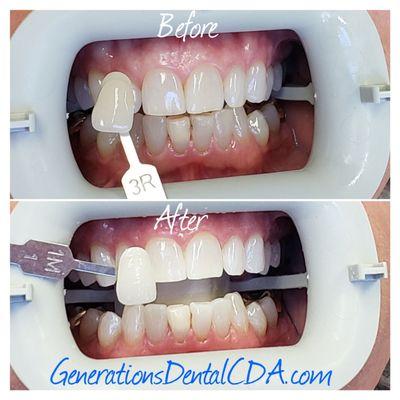 Another Great Whitening Result! GenerationsDentalCDA.com