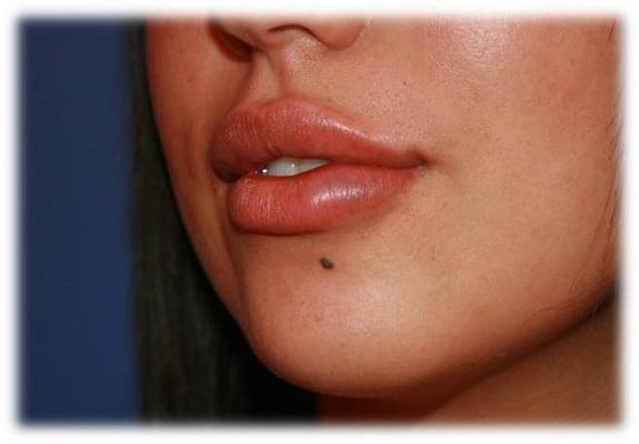 Dermal Filler for lips- Post Procedure