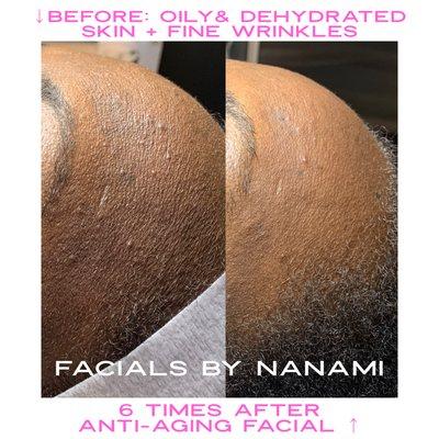 Anti-aging facial for oily skin