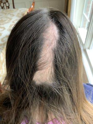 After removal of knot at salon, 13 year old daughter- solution was much worse than the problem.