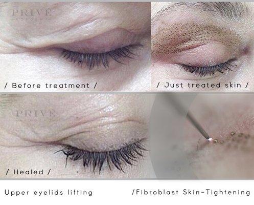 We are offering Plasma Skin Tightening .