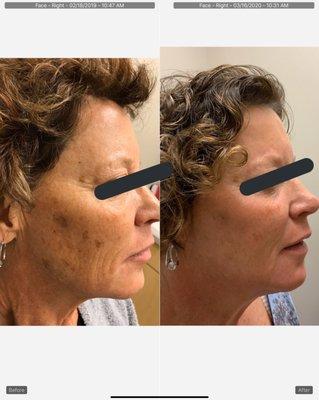 Get rid of your sun spots and look years younger with photofacial treatments! Check out this amazing before and after