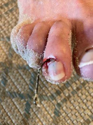 Fishing hook impaled under toe nail on 7/31